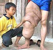 Điều trị bằng thuốc diethylcarbamazin, có tác dụng tiêu diệt nhanh ấu trùng trong máu, nhưng có tác dụng diệt rất chậm hoặc chỉ gây tổn thương cho giun trưởng thành. Nên muốn điều trị khỏi cần uống thuốc trong 3 tuần. Điều trị bằng thuốc diethylcarbamazin, có tác dụng tiêu diệt nhanh ấu trùng trong máu, nhưng có tác dụng diệt rất chậm hoặc chỉ gây tổn thương cho giun trưởng thành. Nên muốn điều trị khỏi cần uống thuốc trong 3 tuần.