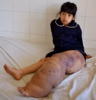 Bệnh chân voi còn có thể xuất hiện do một số nguyên nhân khác, như lao, hủi, nhiễm liên cầu tái phát; hoặc do môi trường (tiếp xúc nhiều với một số kim loại như silic đioxit). Có tài liệu cho rằng, chân voi hay xuất hiện ở những người dân sống tại miền núi Trung Phi, do tiếp xúc quá nhiều với tàn tro của núi lửa. Đôi khi, không thể xác định nguyên nhân gây bệnh.