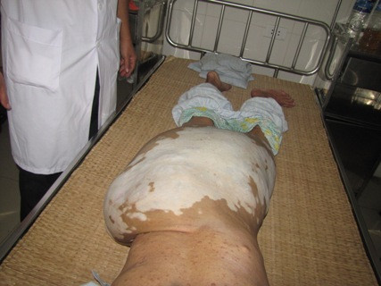 Khối u hơn 10kg trên người chị An Khối u hơn 10kg trên người chị An