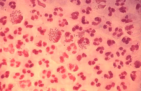 1. Lậu: Lậu là một trong những căn bệnh đang có xu hướng trở lại mạnh mẽ trong vấn đề chăm sóc sức khỏe y tế của con người. Trung tâm Kiểm soát dịch bệnh của Mỹ (CDC) cảnh báo hiện tại chỉ có duy nhất thuốc ceftriaxone, có khả năng điều tra giai đoạn đầu của căn bệnh lây lan qua đường tình dục này. 1. Lậu: Lậu là một trong những căn bệnh đang có xu hướng trở lại mạnh mẽ trong vấn đề chăm sóc sức khỏe y tế của con người. Trung tâm Kiểm soát dịch bệnh của Mỹ (CDC) cảnh báo hiện tại chỉ có duy nhất thuốc ceftriaxone, có khả năng điều tra giai đoạn đầu của căn bệnh lây lan qua đường tình dục này.