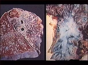 8. Lao phổi: Lao phổi là một trong những căn bệnh đã cướp đi sinh mạng của nhiều nhân vật nổi tiếng trong lịch sử nhân loại như nhà văn gốc Do thái - Franz Kafka, phóng viên người Anh - George Orwell, đệ nhất phu nhân - Eleanor Roosevelt và nhà thơ - Henry David Thoreau. 8. Lao phổi: Lao phổi là một trong những căn bệnh đã cướp đi sinh mạng của nhiều nhân vật nổi tiếng trong lịch sử nhân loại như nhà văn gốc Do thái - Franz Kafka, phóng viên người Anh - George Orwell, đệ nhất phu nhân - Eleanor Roosevelt và nhà thơ - Henry David Thoreau.