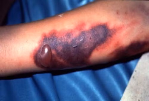 2. Sốt xuất huyết do virus Ebola: Sốt xuất huyết do virus Ebola gây ra là căn bệnh lây nhiễm nhanh chóng và vô cùng nguy hiểm với tỷ lệ tử vong cao. Căn bệnh tử thần này đã hoành hành tại đất nước Uganda vào hồi tháng 7 và cho tới nay đã có 16 người tử vong. Tổ chức Y tế thế giới (WHO) nhận định căn bệnh sốt xuất huyết do virus Ebola hiện đang nằm trong tầm kiểm soát của giới y tế. 2. Sốt xuất huyết do virus Ebola: Sốt xuất huyết do virus Ebola gây ra là căn bệnh lây nhiễm nhanh chóng và vô cùng nguy hiểm với tỷ lệ tử vong cao. Căn bệnh tử thần này đã hoành hành tại đất nước Uganda vào hồi tháng 7 và cho tới nay đã có 16 người tử vong. Tổ chức Y tế thế giới (WHO) nhận định căn bệnh sốt xuất huyết do virus Ebola hiện đang nằm trong tầm kiểm soát của giới y tế.