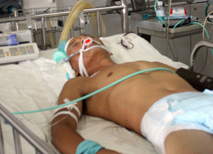 Anh Hòa được BV Trung ương Huế phẫu thuật và đã qua cơn nguy kịch - Ảnh: B.N.L Anh Hòa được BV Trung ương Huế phẫu thuật và đã qua cơn nguy kịch - Ảnh: B.N.L