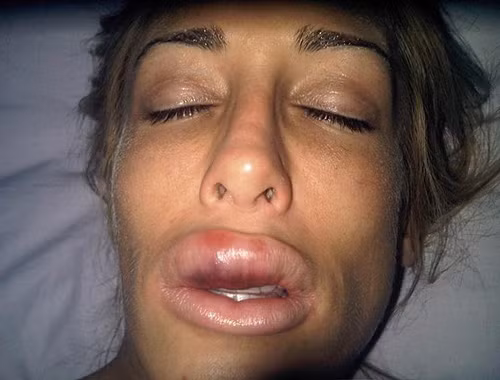 Laura với đôi môi sưng vù. Laura với đôi môi sưng vù.