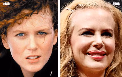 "Thiên nga Úc" Nicole Kidman muốn giữ vẻ quyến rũ cho mình bằng đôi môi căng mọng không tự nhiên.