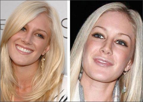 Không có lý do gì để cô nàng "ưa dao kéo" Heidi Montag không chăm chút đôi môi bằng botox. Không có lý do gì để cô nàng "ưa dao kéo" Heidi Montag không chăm chút đôi môi bằng botox.