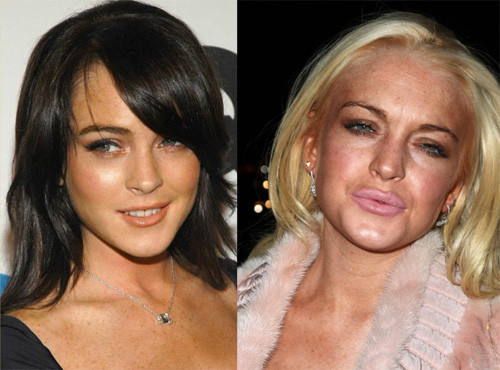 Lindsay Lohan ngày càng lún sâu vào con đường nghiện bơm môi. Lindsay Lohan ngày càng lún sâu vào con đường nghiện bơm môi.
