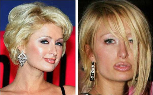 Paris Hilton với đôi môi sưng phồng sau khi tiêm botox. Paris Hilton với đôi môi sưng phồng sau khi tiêm botox.