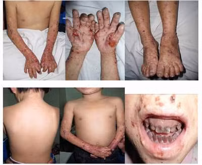 Thế giới chưa có phương pháp điều trị tận gốc bệnh Porphyrin ngoài cách điều cắt lá lách để giảm tình trạng thiếu máu, điều trị vùng da nhiễm khuẩn và một số trường hợp được cấy ghép tủy xương. Cô bé Tr phải tránh ánh nắng mặt trời, chú ý chăm sóc da để tránh những tổn thương cho da. Cô bé phải chịu những đau đớn về thể xác và sẽ phải đối diện với những khó khăn không nhỏ trong cuộc sống...