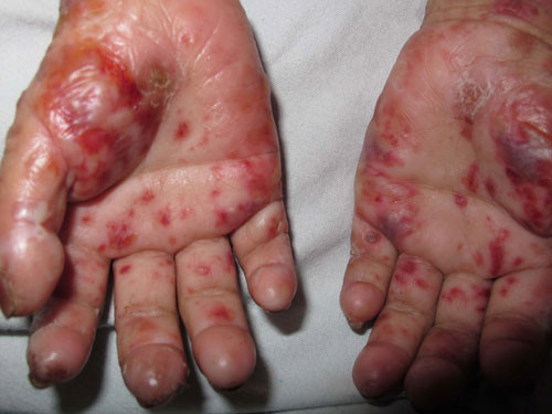 Căn bệnh “ma cà rồng” mà cô bé Nguyễn Thu Tr ( quê tại Sóc Sơn- Hà Nội) mắc phải cũng là một căn bệnh rất lạ, lần đầu tiên xuất hiện ở nước ta. Trên da cô bé chằng chịt các bọng nước phồng rộp, chứa dịch trong, dịch hồng, có những vết trầy tiết dịch, có vảy tiết và sẹo bọng nước trên vùng da hở, từ mặt đến tay và chân. Thêm vào đó, sẹo lồi với mật độ dày đặc xuất hiện trên nền tổn thương cũ ở mặt, cổ, tay và chân, những vùng da hở tiếp xúc ánh nắng. Các vết sẹo này đã làm cho khuôn mặt, tay, chân cô bé biến dạng kỳ dị. Các đầu ngón tay, chân bị teo do sẹo.