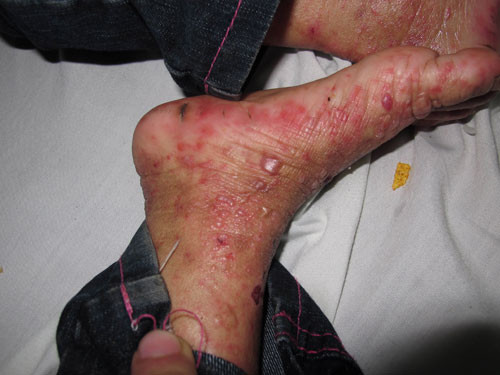 Cô bé còn bị mắc chứng rậm lông và phát triển thể chất không bình thường, chỉ nặng 13kg và có hội chứng thiếu máu. Tuy nhiên những vùng da kín được quần áo che phủ, ít tiếp xúc ánh nắng như lưng, bụng và phần trên ở cánh tay, ở đùi, mông da hoàn toàn bình thường. Cô bé được chẩn đoán là mắc căn bệnh có tên là Porphyrin (mọi người thường gọi là căn bệnh ma cà rồng).