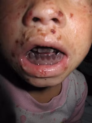 Theo TS Nguyễn Duy Hưng, Tổng thư ký Hội Da liễu Việt Nam, Porphyrin là căn bệnh hiếm gặp của cả nhân loại. Đến nay mới chỉ phát hiện khoảng 200 trường hợp từ nhẹ đến nặng. Nhiều người gọi đây là “bệnh ma cà rồng” bởi đặc tính bùng phát tổn thương da khi tiếp xúc trực tiếp với ánh nắng mặt trời và hậu quả để lại những vết sẹo gây biến dạng khủng khiếp trên mặt, tay, chân bệnh nhân, thậm chí gây co quắp, rụt các chi.