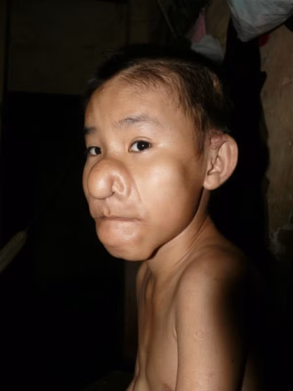 Căn bệnh quái ác này dường như đã cướp đi tuổi thơ của cậu bé. Phải chịu đau đớn nhưng Minh Tiến rất ngoan. Cậu bé luôn là học sinh tiên tiến, cố gắng sống vui vẻ, vượt qua mặc cảm để hòa đồng với mọi người.