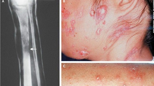 Bệnh lạ giống HIV: Căn bệnh này không chỉ gây hoang mang trong người dân người dân mà cộng đồng các chuyên gia y tế Việt Nam cũng xôn xao trước kết luận chính thức của các nhà nghiên cứu tại Viện Y tế quốc gia Mỹ (NIH) về việc xác định căn bệnh lạ giống HIV/AIDS mới tại châu Á, Đông Nam Á gây ra triệu chứng suy giảm miễn dịch như bệnh AIDS nhưng không liên quan đến HIV. Bệnh lạ giống HIV: Căn bệnh này không chỉ gây hoang mang trong người dân người dân mà cộng đồng các chuyên gia y tế Việt Nam cũng xôn xao trước kết luận chính thức của các nhà nghiên cứu tại Viện Y tế quốc gia Mỹ (NIH) về việc xác định căn bệnh lạ giống HIV/AIDS mới tại châu Á, Đông Nam Á gây ra triệu chứng suy giảm miễn dịch như bệnh AIDS nhưng không liên quan đến HIV.