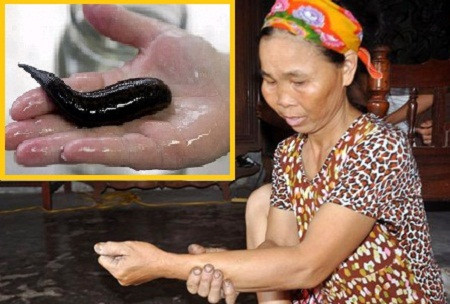 Người đàn bà đẻ ra “đỉa” khổng lồ: Sự việc xảy vào vào những ngày đầu tháng 7/2012 tại Diễn Châu, Nghệ An. Theo các chuyên gia để phát hiện đỉa xâm nhập vào cơ thể có thể chụp X-quang để phát hiện và dùng dụng cụ chuyên dụng gắp ra. Nếu phát hiện chúng xâm nhập vào khoang mũi, miệng hay bộ phận sinh dục có thể súc bằng nước muối mặn và hít chất cay để chúng tự chui ra. Người đàn bà đẻ ra “đỉa” khổng lồ: Sự việc xảy vào vào những ngày đầu tháng 7/2012 tại Diễn Châu, Nghệ An. Theo các chuyên gia để phát hiện đỉa xâm nhập vào cơ thể có thể chụp X-quang để phát hiện và dùng dụng cụ chuyên dụng gắp ra. Nếu phát hiện chúng xâm nhập vào khoang mũi, miệng hay bộ phận sinh dục có thể súc bằng nước muối mặn và hít chất cay để chúng tự chui ra.