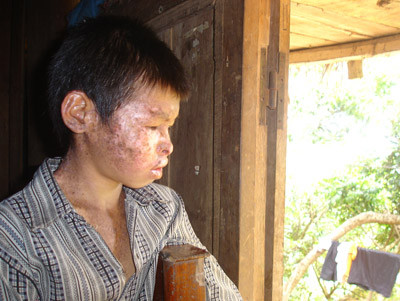 Biến thành "quái nhân" vì viêm dây thần kinh ở Hòa Bình: Theo các chuyên gia thì đây là “Hội chứng viêm nhiều dây thần kinh có liên quan đến vitatmin B1”, Bộ y tế cũng khẳng định đây là căn bệnh dễ nhầm lẫn với các bệnh khác, nên trong quá trình điều trị đạt kết quả chưa cao và cần được tiếp tục nghiên cứu để đưa ra biện pháp khắc phục hiệu quả nhất. Biến thành "quái nhân" vì viêm dây thần kinh ở Hòa Bình: Theo các chuyên gia thì đây là “Hội chứng viêm nhiều dây thần kinh có liên quan đến vitatmin B1”, Bộ y tế cũng khẳng định đây là căn bệnh dễ nhầm lẫn với các bệnh khác, nên trong quá trình điều trị đạt kết quả chưa cao và cần được tiếp tục nghiên cứu để đưa ra biện pháp khắc phục hiệu quả nhất.