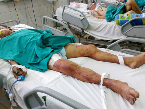 Một bệnh nhân nhiễm liên cầu khuẩn heo sau khi ăn lòng heo và tiết canh. Một bệnh nhân nhiễm liên cầu khuẩn heo sau khi ăn lòng heo và tiết canh.