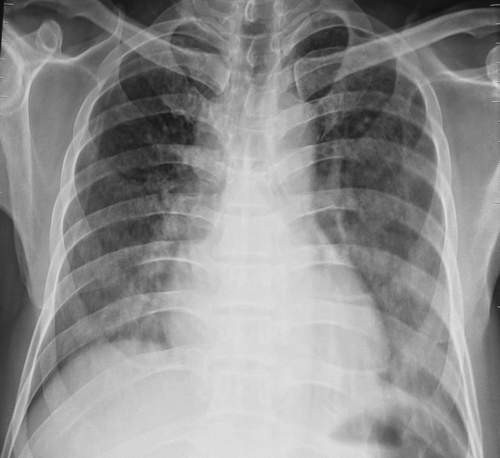 Hình ảnh nấm phổi. Hình ảnh nấm phổi.