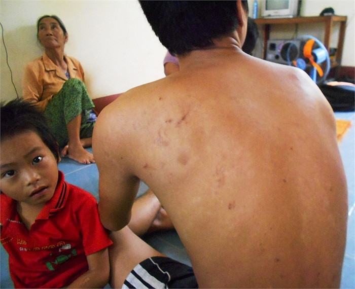 Khắp cơ thể anh Trần Văn Sang con chị Tý đầy rẫy những vết sẹo do côn trùng đốt để lại Khắp cơ thể anh Trần Văn Sang con chị Tý đầy rẫy những vết sẹo do côn trùng đốt để lại