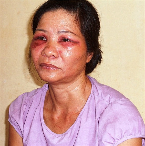 Vùng mắt chị Nguyễn Thị Tý bị sưng húp, đỏ tái, mọng mủ và đau rát do côn trùng lạ cắn Vùng mắt chị Nguyễn Thị Tý bị sưng húp, đỏ tái, mọng mủ và đau rát do côn trùng lạ cắn