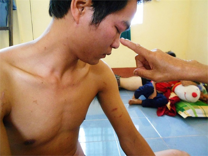 Khắp cơ thể và mắt sưng húp sau khi bị côn trùng đốt Khắp cơ thể và mắt sưng húp sau khi bị côn trùng đốt