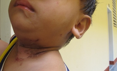 Cháu Nguyễn văn Tuấn (hơn 1 tuổi) con chị Lê Thị Bé tại phòng G5-303 khu tái định cư bị như thế này từ 5 ngày nay. Cháu Nguyễn văn Tuấn (hơn 1 tuổi) con chị Lê Thị Bé tại phòng G5-303 khu tái định cư bị như thế này từ 5 ngày nay.