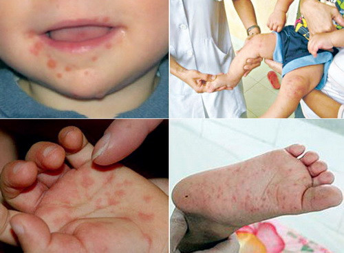 Bệnh lây lan trực tiếp từ người sang người, qua dịch tiết mũi họng, nước bọt, các mụn nước, hoặc phân của người bệnh. Nguyên nhân hàng đầu là do coxsackievirus A16, một loại virus thuộc họ enterovirus. Cũng có thể do các loại enterviruses khác gây ra nhưng ít gặp hơn. Đặc biệt enterovirus 71 ít gặp hơn nhưng có nhiều nguy cơ gây biến chứng nặng hơn, như viêm màng não, viêm cơ tim… dẫn đến tử vong. Bệnh lây lan trực tiếp từ người sang người, qua dịch tiết mũi họng, nước bọt, các mụn nước, hoặc phân của người bệnh. Nguyên nhân hàng đầu là do coxsackievirus A16, một loại virus thuộc họ enterovirus. Cũng có thể do các loại enterviruses khác gây ra nhưng ít gặp hơn. Đặc biệt enterovirus 71 ít gặp hơn nhưng có nhiều nguy cơ gây biến chứng nặng hơn, như viêm màng não, viêm cơ tim… dẫn đến tử vong.