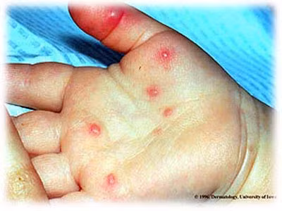 Bệnh thường xảy ra theo mùa nóng ấm. Ở vùng ôn đới, bệnh phổ biến ở mùa hè và đầu thu. Còn ở các nước khí hậu nhiệt đới, hầu như bệnh xuất hiện quanh năm, nhưng mùa hè vẫn có tần suất cao nhất.