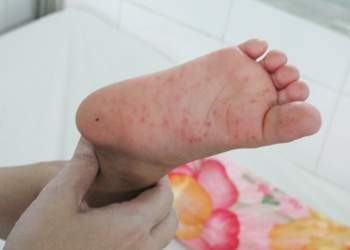 Biểu hiện đặc trưng của bệnh bởi sốt, đau họng và nổi ban có bọng nước. Triệu chứng đầu tiên thường là sốt nhẹ, biếng ăn, mệt mỏi và đau họng. Một đến hai ngày sau khi xuất hiện sốt trẻ bắt đầu đau miệng. Biểu hiện đặc trưng của bệnh bởi sốt, đau họng và nổi ban có bọng nước. Triệu chứng đầu tiên thường là sốt nhẹ, biếng ăn, mệt mỏi và đau họng. Một đến hai ngày sau khi xuất hiện sốt trẻ bắt đầu đau miệng.