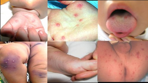 Tuy nhiên ban có thể xuất hiện ở mông. Một số trường hợp, ban chỉ xuất hiện ở miệng mà không thấy ở các vị trí khác. Tuy nhiên ban có thể xuất hiện ở mông. Một số trường hợp, ban chỉ xuất hiện ở miệng mà không thấy ở các vị trí khác.