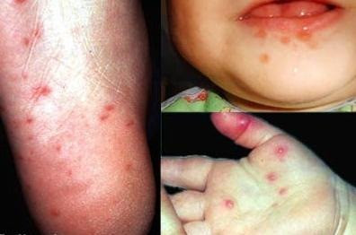 Ban này không ngứa và thường khu trú ở lòng bàn tay hoặc lòng bàn chân. Như vậy ban điển hình thường xuất hiện ở các vị trí tay, chân và miệng nên bệnh có tên Bệnh Tay – Chân - Miệng. Ban này không ngứa và thường khu trú ở lòng bàn tay hoặc lòng bàn chân. Như vậy ban điển hình thường xuất hiện ở các vị trí tay, chân và miệng nên bệnh có tên Bệnh Tay – Chân - Miệng.