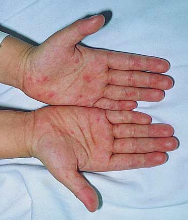 Khám họng trẻ có thể phát hiện các chấm đỏ nhỏ sau đó biến thành các bọng nước và thường tiến triển đến loét. Các tổn thương này có thể thấy ở lưỡi, nướu và bên trong má. Ban da xuất hiện trong vòng 1 đến 2 ngày với các tổn thương phẳng trên da hoặc có thể gồ lên, máu đỏ và một số hình thành bọng nước Khám họng trẻ có thể phát hiện các chấm đỏ nhỏ sau đó biến thành các bọng nước và thường tiến triển đến loét. Các tổn thương này có thể thấy ở lưỡi, nướu và bên trong má. Ban da xuất hiện trong vòng 1 đến 2 ngày với các tổn thương phẳng trên da hoặc có thể gồ lên, máu đỏ và một số hình thành bọng nước