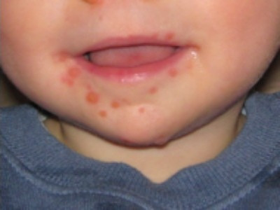 Bệnh tay, chân và miệng (TCM) là một hội chứng bệnh ở người do virus đường ruột của họ Picornaviridae gây ra. Giống vi rút gây bệnh TCM phổ biến nhất là Coxsackie A và virus Enterovirus 71 (EV-71). Đây là một bệnh thường gặp ở nhũ nhi và trẻ em. Bệnh tay, chân và miệng (TCM) là một hội chứng bệnh ở người do virus đường ruột của họ Picornaviridae gây ra. Giống vi rút gây bệnh TCM phổ biến nhất là Coxsackie A và virus Enterovirus 71 (EV-71). Đây là một bệnh thường gặp ở nhũ nhi và trẻ em.