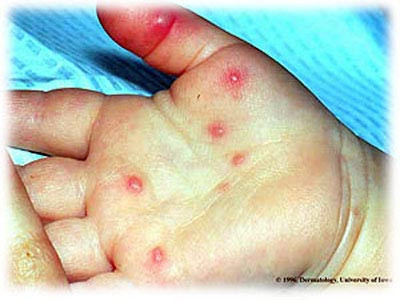 Bệnh thường xảy ra theo mùa nóng ấm. Ở vùng ôn đới, bệnh phổ biến ở mùa hè và đầu thu. Còn ở các nước khí hậu nhiệt đới, hầu như bệnh xuất hiện quanh năm, nhưng mùa hè vẫn có tần suất cao nhất. Bệnh thường xảy ra theo mùa nóng ấm. Ở vùng ôn đới, bệnh phổ biến ở mùa hè và đầu thu. Còn ở các nước khí hậu nhiệt đới, hầu như bệnh xuất hiện quanh năm, nhưng mùa hè vẫn có tần suất cao nhất.