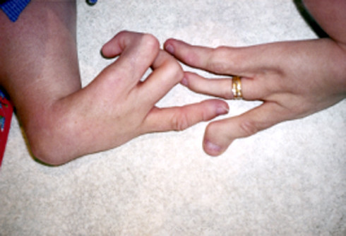 Nhiều trẻ em bị dị tật bẩm sinh do sản phụ uống thuốc Thalidomide khi mang thai. Ảnh: AFP . Nhiều trẻ em bị dị tật bẩm sinh do sản phụ uống thuốc Thalidomide khi mang thai. Ảnh: AFP .