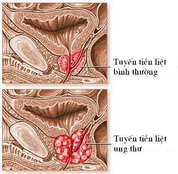 Ung thư tuyến tiền liệt: Bệnh nhân ung thư tuyến tiền liệt thường được điều trị hoóc môn (để ngăn quá trình sản xuất hoóc môn testosterone). Mà testosterone lại rất quan trọng trong việc tạo sự cứng chắc cho bộ xương cơ thể. Vì thế, để bù đắp, bệnh nhân thường được bổ sung canxi. Ung thư tuyến tiền liệt: Bệnh nhân ung thư tuyến tiền liệt thường được điều trị hoóc môn (để ngăn quá trình sản xuất hoóc môn testosterone). Mà testosterone lại rất quan trọng trong việc tạo sự cứng chắc cho bộ xương cơ thể. Vì thế, để bù đắp, bệnh nhân thường được bổ sung canxi.