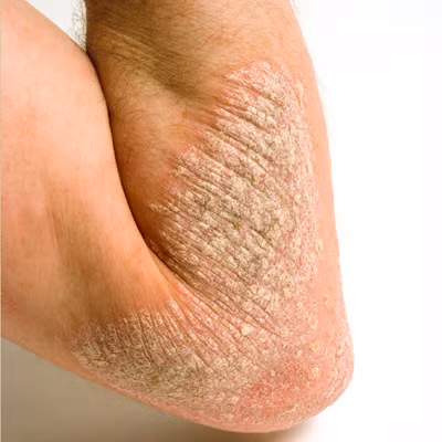 Do vậy, việc dùng quá nhiều (vượt 0,7 mg mỗi ngày với đàn ông, và 0,6 mg mỗi ngày cho phụ nữ) có thể dẫn tới các vấn đề như viêm màng kết, rụng tóc, và làm tồi tệ thêm vấn đề về da.