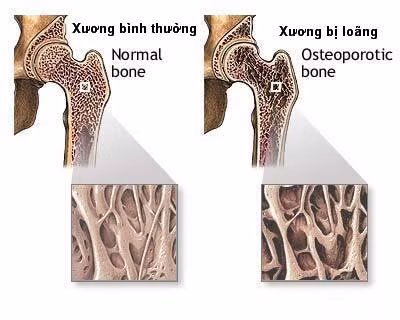 Chứng loãng xương: Tránh vitamin A và photpho, có cơ chế làm việc liên hệ chặt chẽ với canxi, phốt pho rất quan trọng trong việc tạo cho bộ xương khỏe mạnh, và mặc dù không được chỉ định, nhiều người vẫn tự uống.