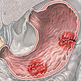Loét dạ dày: Tránh vitamin A, loét dạ dày do vi khuẩn Helicobacter pylori thường được điều trị bằng kháng sinh tetracycline. Tuy nhiên, sẽ là nghiêm trọng nếu bạn uống vitamin A bổ sung kèm theo thuốc này. Loét dạ dày: Tránh vitamin A, loét dạ dày do vi khuẩn Helicobacter pylori thường được điều trị bằng kháng sinh tetracycline. Tuy nhiên, sẽ là nghiêm trọng nếu bạn uống vitamin A bổ sung kèm theo thuốc này.
