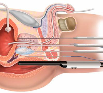Tuy nhiên, một nghiên cứu gần đây khi tìm hiểu các bệnh nhân dùng liệu pháp hoóc môn, có bổ sung canxi thì thấy, khi được bổ sung 500-1000 mg canxi mỗi ngày, những người đàn ông này bị giảm mật độ xương. Đó là vì canxi quá nhiều đã làm giảm hiệu quả của vitamin D - vốn cần thiết để hấp thụ xương. Tuy nhiên, một nghiên cứu gần đây khi tìm hiểu các bệnh nhân dùng liệu pháp hoóc môn, có bổ sung canxi thì thấy, khi được bổ sung 500-1000 mg canxi mỗi ngày, những người đàn ông này bị giảm mật độ xương. Đó là vì canxi quá nhiều đã làm giảm hiệu quả của vitamin D - vốn cần thiết để hấp thụ xương.