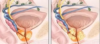 Thực tế, bệnh nhân chỉ cần duy trì vận động để giữ cho xương chắc khỏe trong giai đoạn này, sau điều trị, mật độ xương sẽ dần dần được khôi phục.