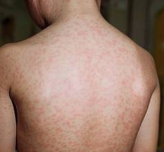 2. Sốt phát ban là một bệnh hay gặp ở trẻ em, tác nhân gây bệnh là virus Rubella. Bệnh biểu hiện với hai triệu chứng nổi bật: hạch ngoại vi to và nổi ban đỏ trên da. Bệnh nhân bị lây bệnh do hít phải chất tiết từ niêm mạc đường hô hấp của người bị bệnh. 2. Sốt phát ban là một bệnh hay gặp ở trẻ em, tác nhân gây bệnh là virus Rubella. Bệnh biểu hiện với hai triệu chứng nổi bật: hạch ngoại vi to và nổi ban đỏ trên da. Bệnh nhân bị lây bệnh do hít phải chất tiết từ niêm mạc đường hô hấp của người bị bệnh.