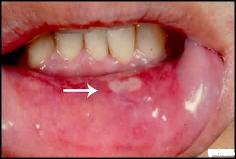 8. Nhiệt miệng: Nguyên nhân gây nhiệt miệng ngoài do khí hậu khô hanh còn do miệng bị tổn thương, thiếu dinh dưỡng, thay đổi nội tiết tố gây ra. Hàng ngày luôn giữ vệ sinh răng miệng, súc miệng bằng nước muối vào sáng sớm, kiêng rượu, thuốc lá, sinh hoạt điều độ và ngủ đủ giấc... là những biện pháp hữu hiệu tránh nhiệt miệng. 8. Nhiệt miệng: Nguyên nhân gây nhiệt miệng ngoài do khí hậu khô hanh còn do miệng bị tổn thương, thiếu dinh dưỡng, thay đổi nội tiết tố gây ra. Hàng ngày luôn giữ vệ sinh răng miệng, súc miệng bằng nước muối vào sáng sớm, kiêng rượu, thuốc lá, sinh hoạt điều độ và ngủ đủ giấc... là những biện pháp hữu hiệu tránh nhiệt miệng.