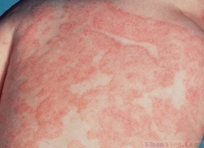 Ngày đầu các ban mọc ở mặt rồi lan dần xuống thân mình, các chi và nhanh chóng lan ra toàn thân. Sang ngày thứ 2 các ban bắt đầu nhạt màu dần. Ngày thứ 3 các ban biến mất hoàn toàn không để lại sẹo, không để lại vết thâm. Ngày đầu các ban mọc ở mặt rồi lan dần xuống thân mình, các chi và nhanh chóng lan ra toàn thân. Sang ngày thứ 2 các ban bắt đầu nhạt màu dần. Ngày thứ 3 các ban biến mất hoàn toàn không để lại sẹo, không để lại vết thâm.