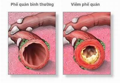 3. Bệnh viêm phế quản là một bệnh khá thường gặp ở bất kỳ lứa tuổi nào. Bệnh thường nặng và nguy hiểm đối với trẻ em và người cao tuổi. Đó là tình trạng đường thở hay còn gọi là phế quản bị viêm nhiễm, đa phần là do nguyên nhân nhiễm trùng: có thể từ bên ngoài đến hoặc do các vi khuẩn ký sinh bình thường trong đường cổ họng gây bệnh khi cơ thể lâm vào các điều kiện bất lợi, nhất là thay đổi thời tiết. 3. Bệnh viêm phế quản là một bệnh khá thường gặp ở bất kỳ lứa tuổi nào. Bệnh thường nặng và nguy hiểm đối với trẻ em và người cao tuổi. Đó là tình trạng đường thở hay còn gọi là phế quản bị viêm nhiễm, đa phần là do nguyên nhân nhiễm trùng: có thể từ bên ngoài đến hoặc do các vi khuẩn ký sinh bình thường trong đường cổ họng gây bệnh khi cơ thể lâm vào các điều kiện bất lợi, nhất là thay đổi thời tiết.