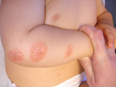 7. Dị ứng da: Dị ứng da là một loại bệnh rất phổ biến vào mùa thu. Nhiệt độ giảm, hanh khô là lúc bệnh dị ứng này có cơ hội phát triển. Dị ứng da có thể xảy ra cấp tính hoặc mãn tính, có thể tại chỗ hoặc toàn thân nhưng chủ yếu là do da khô. 7. Dị ứng da: Dị ứng da là một loại bệnh rất phổ biến vào mùa thu. Nhiệt độ giảm, hanh khô là lúc bệnh dị ứng này có cơ hội phát triển. Dị ứng da có thể xảy ra cấp tính hoặc mãn tính, có thể tại chỗ hoặc toàn thân nhưng chủ yếu là do da khô.