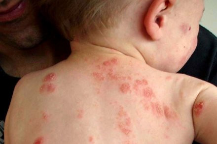Để giảm thiểu sự trầm trọng của dị ứng bạn nên đặc biệt chú ý đến không khí trong nhà sao cho thông thoáng, sạch sẽ bởi mùa thu thường có nhiều loại côn trùng xuất hiện hơn. Để giảm thiểu sự trầm trọng của dị ứng bạn nên đặc biệt chú ý đến không khí trong nhà sao cho thông thoáng, sạch sẽ bởi mùa thu thường có nhiều loại côn trùng xuất hiện hơn.