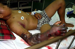 Một bệnh nhân bị côn trùng cắn Một bệnh nhân bị côn trùng cắn