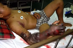 Một bệnh nhân bị côn trùng cắn