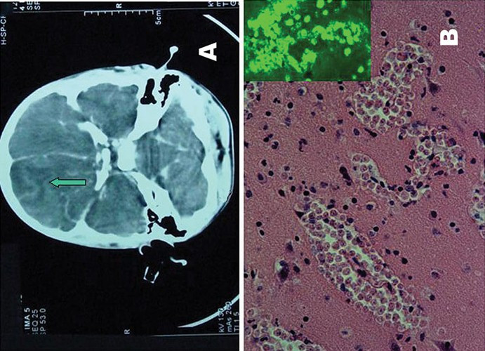 'Amip ăn não người' cướp mạng sống một thanh niên Ngày 31/7 vừa qua, anh Hữu, 25 tuổi, ngụ Phú Yên, tạm trú tại Bình Thạnh, TP HCM, tử vong sau một ngày nhập viện. Kết quả xét nghiệm tại Bệnh viện Bệnh Nhiệt đới cho thấy anh mắc phải loại “amip ăn não người”. Đây là trường hợp đầu tiên được Bệnh viện Bệnh Nhiệt đới phát hiện bị nhiễm “amip ăn não người”. 'Amip ăn não người' cướp mạng sống một thanh niên Ngày 31/7 vừa qua, anh Hữu, 25 tuổi, ngụ Phú Yên, tạm trú tại Bình Thạnh, TP HCM, tử vong sau một ngày nhập viện. Kết quả xét nghiệm tại Bệnh viện Bệnh Nhiệt đới cho thấy anh mắc phải loại “amip ăn não người”. Đây là trường hợp đầu tiên được Bệnh viện Bệnh Nhiệt đới phát hiện bị nhiễm “amip ăn não người”.